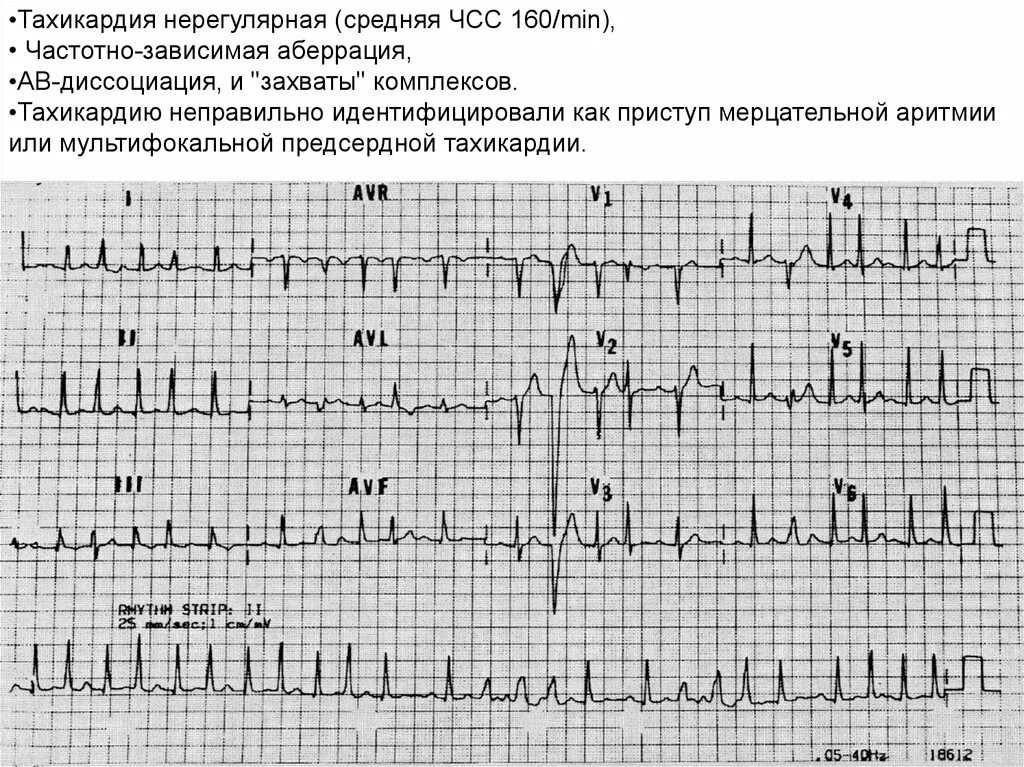 Сильное сердцебиение при нагрузках. Нерегулярная предсердная тахикардия. Многофокусная предсердная тахикардия на ЭКГ. Желудочковая тахикардия на ЭКГ С АВ блокадой. Предсердная тахикардия на ЭКГ.