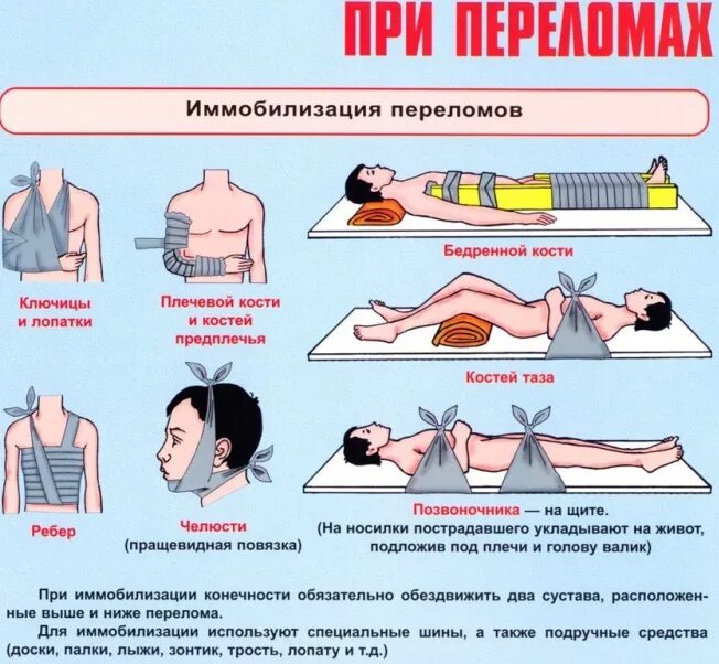 При оказании первой медицинской помощи при переломе. Действия по оказанию первой помощи при переломе костей конечностей. Последовательность оказания первой медицинской помощи при переломах. При оказании первой медицинской помощи при переломе необходимо:.