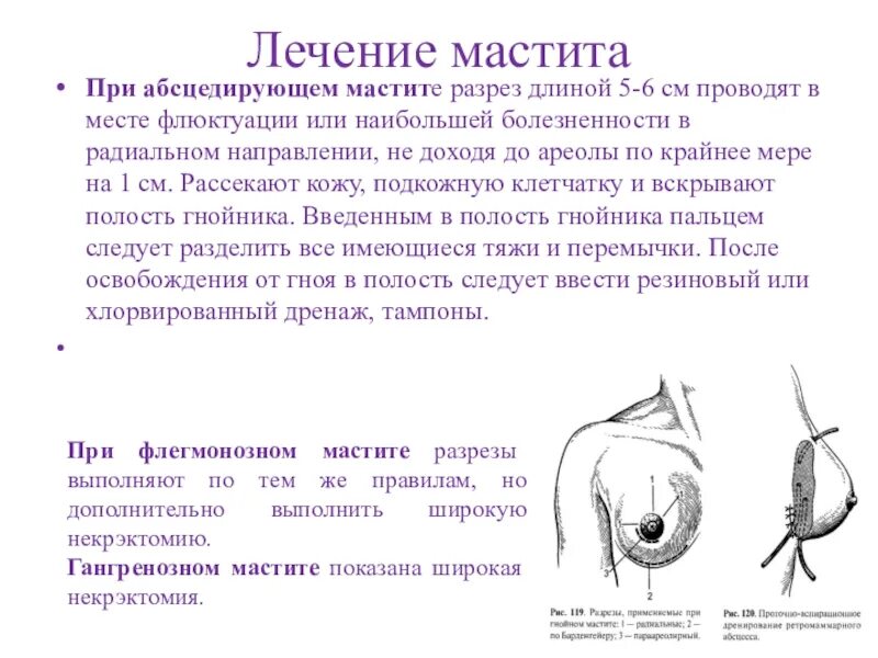 Принципы лечения мастита. Радиальные разрезы при мастите. Мастит хирургическое лечение. Консервативная терапия мастита. Мастит хирургическое лечение.