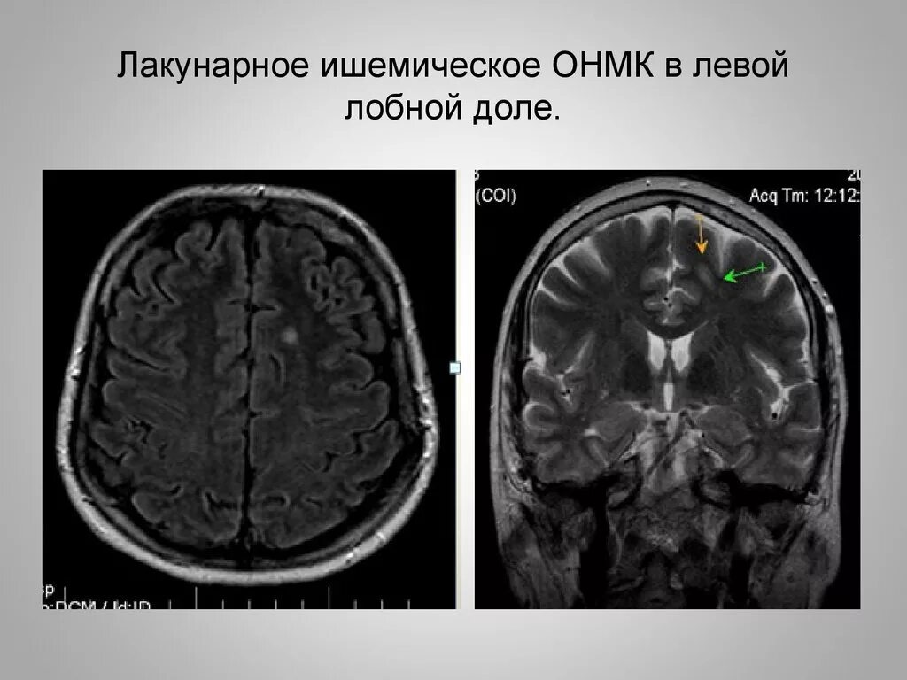 Киста в лобной доле. Лакунарный ишемический инсульт мрт. Ишемический инсульт кт и мрт. Лакунарный ишемический инсульт кт. ОНМК на мрт головного мозга.