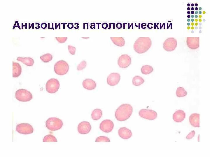 Пойкилоцитоз анемия. Анизоцитоз. Патологический анизоцитоз. Анизоцитоз и пойкилоцитоз. На клеточный анизоцитоз.