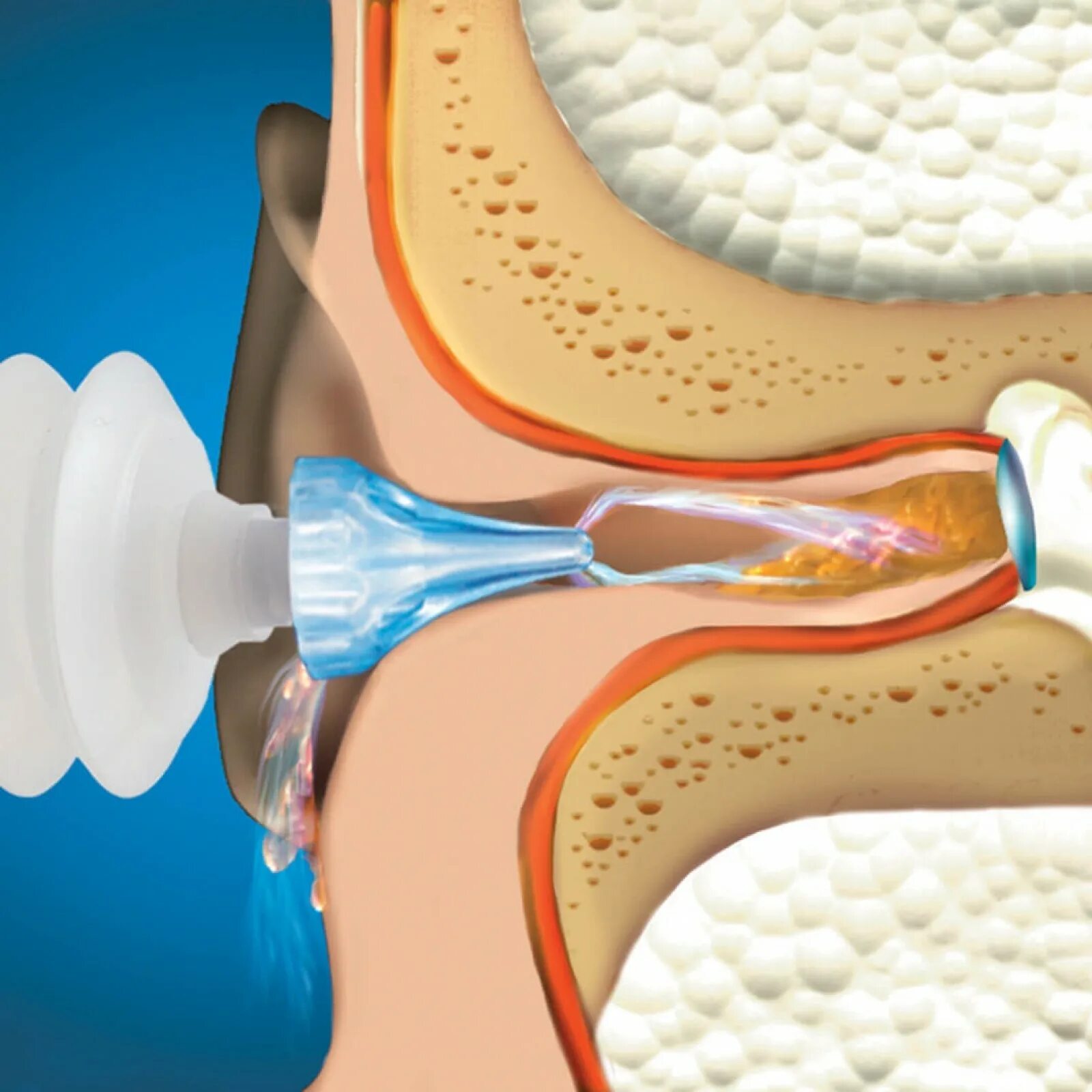 Аппарат для промывания ушей от серных пробок. Промывание среднего уха. Как промыть ухо водой