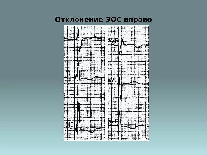 Отклонение ЭОС вправо на ЭКГ. Отклонение ЭОС влево на ЭКГ. ЭКГ ось смещена вправо. Отклонение электрической оси влево на ЭКГ. Сердце отклонено вправо