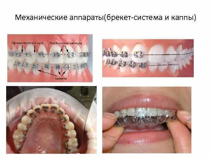 Брекеты: стоимость в Москве на установку системы под ключ на обе челюсти в клини