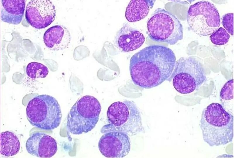 1 плазматическая клетка. Плазматические клетки в мазке крови. Миеломная болезнь плазматические клетки. Плазматические клетки 52,2%. Лимфоциты с плазматизацией цитоплазмы.