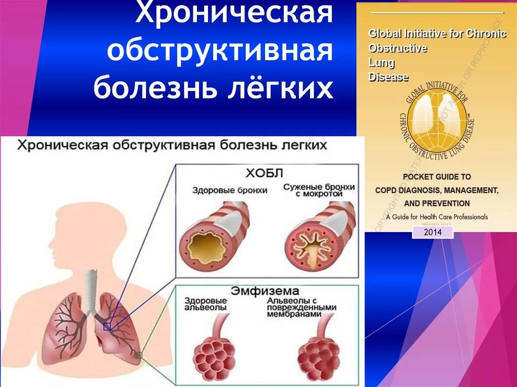 Бронхит хобл. Хроническая обструктивная болезнь легких. Хроническая обструктивная болезнь легких (ХОБЛ).