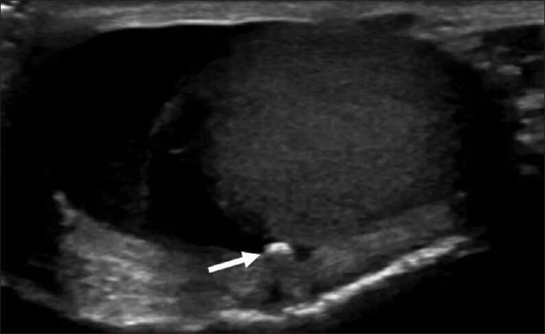 Киста придатка яичка на УЗИ. Кальцинаты яичка у мужчин на УЗИ. Микрокальцинаты яичка УЗИ.