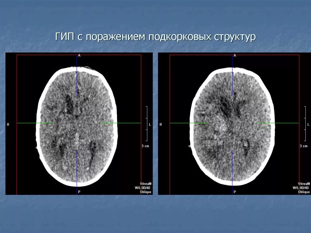 Подкорковые поражения мозга. Поражение подкорковых структур. Структуры головного мозга на кт. Подкорковые структуры мозга. Подкорковые структуры мозга кт.