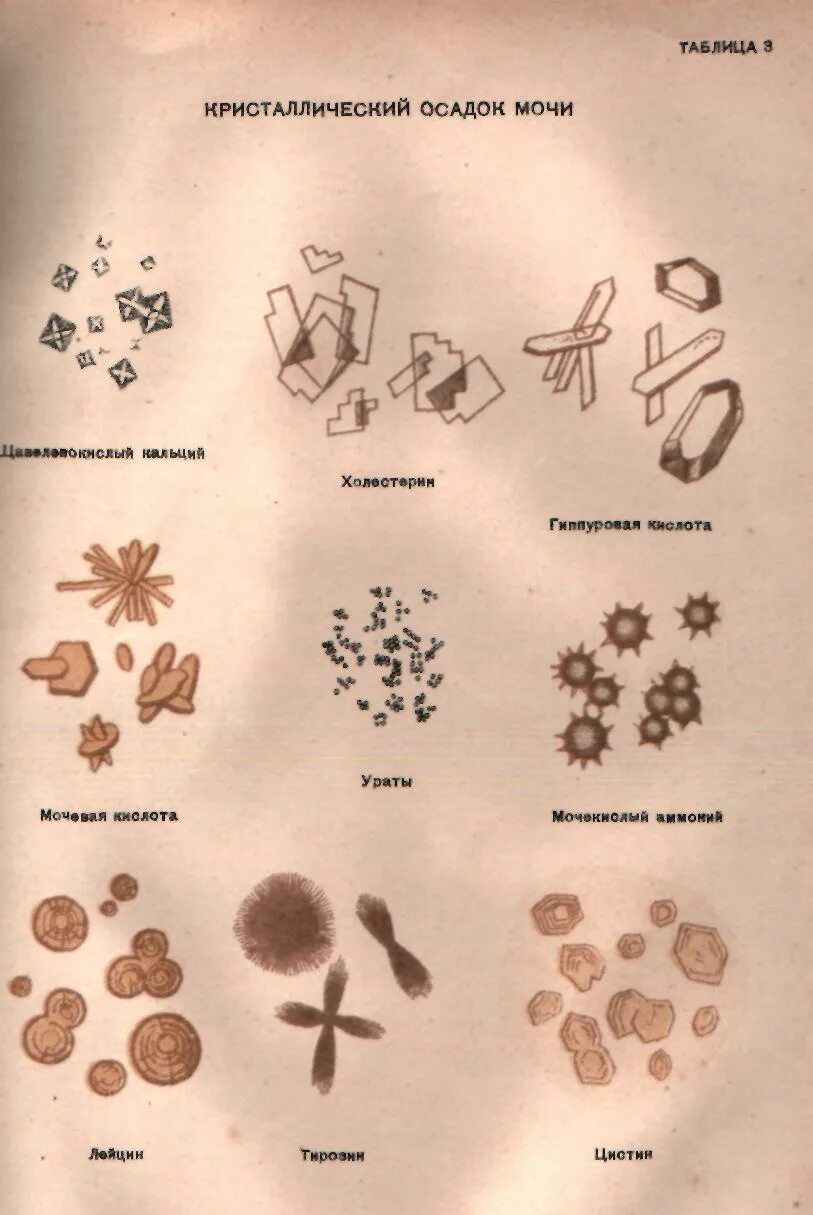 Иглы в моче. Кристаллы мочекислого аммония в моче под микроскопом. Кристаллы мочекислого аммония в моче у ребенка. Кристаллы мочевой кислоты в моче микроскопия. Микроскопия осадка мочи мочекислый аммоний.