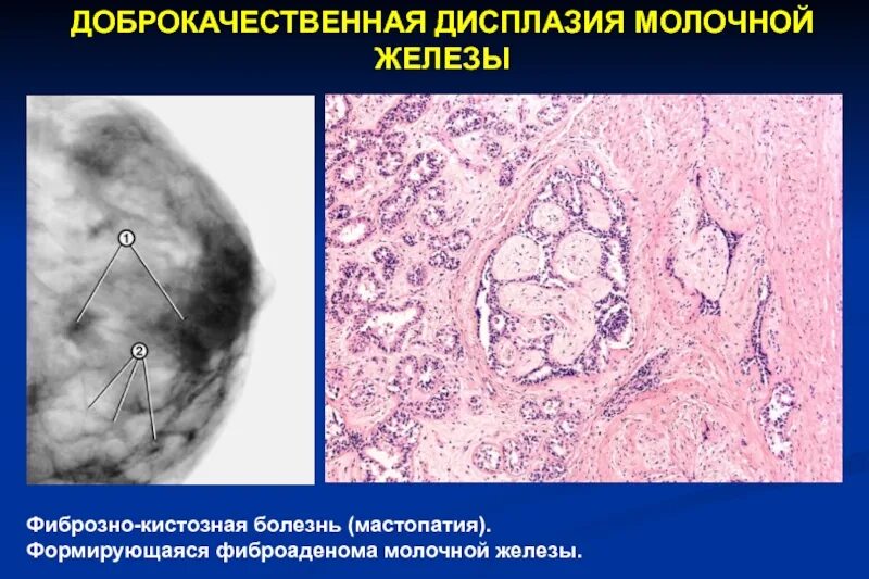 Периканаликулярная фиброаденома молочной железы гистология. Фиброаденома молочной железы гистология. Фиброкистозная мастопатия молочной железы. Гистология кистозная мастопатия. Фиброаденоматоз bi