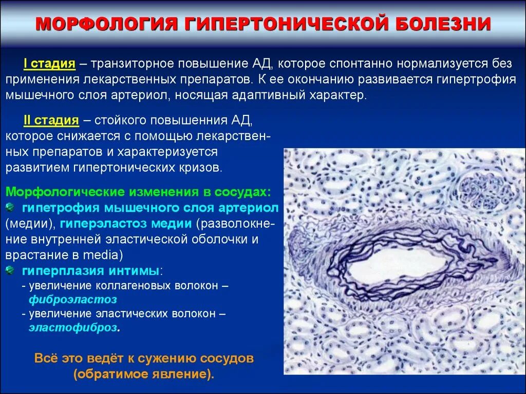 Морфологические изменения болезни. Стадии гипертонической болезни патанатомия. Структурные изменения сосудов при гипертонической болезни. Морфологические изменения при гипертонической болезни патанатомия. Изменения артериол при гипертонической болезни.