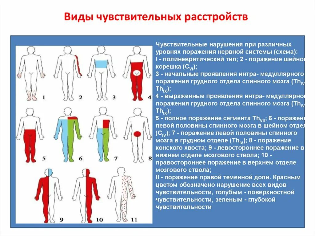 Периферический корешковый Тип нарушения чувствительности. Проводниковый и сегментарный Тип нарушения чувствительности. Периферический мононевритический Тип нарушения чувствительности. Спинально проводниковый Тип нарушения чувствительности. Отсутствие чувствительности латынь