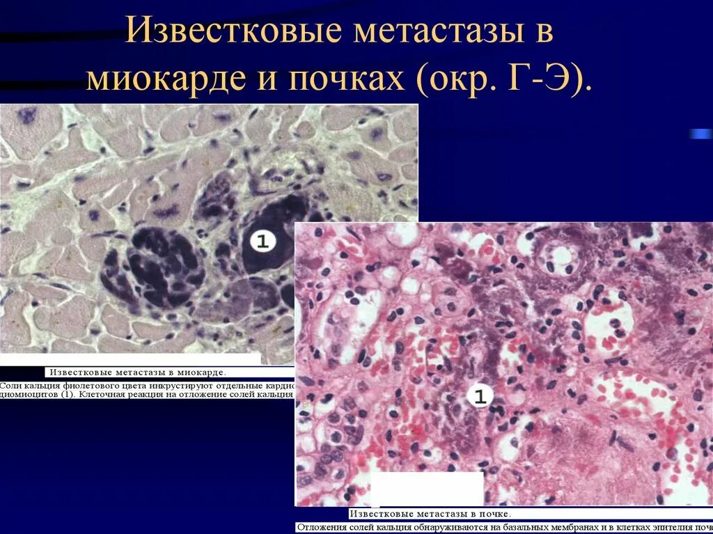Отложение кальция