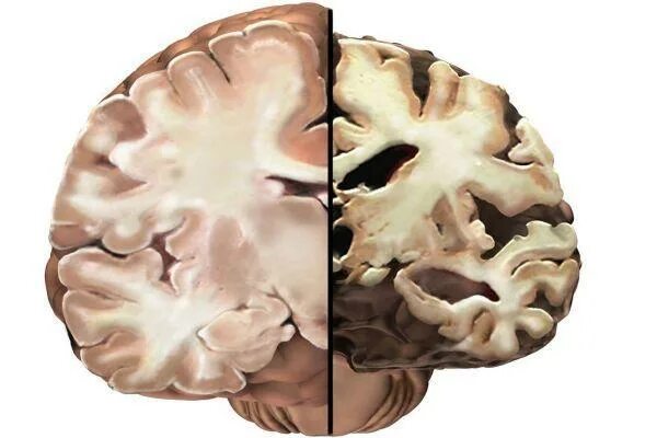 Необратимые изменения мозга. Отмирание клеток головного мозга. Мозг здоровый и Альцгеймера. Атрофические заболевания головного мозга.