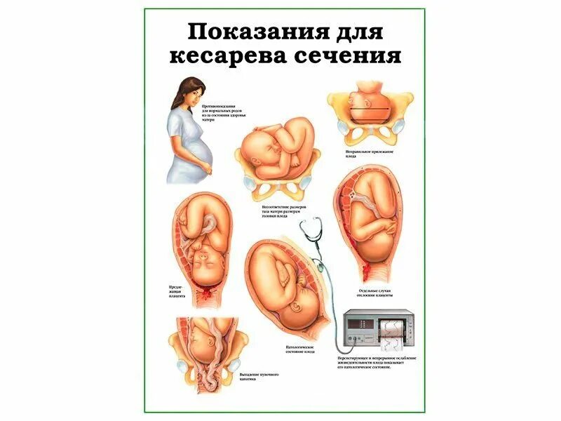 Показания для кесарева сечения. Разрезы при кесаревом сечении. Операция кесарево показания