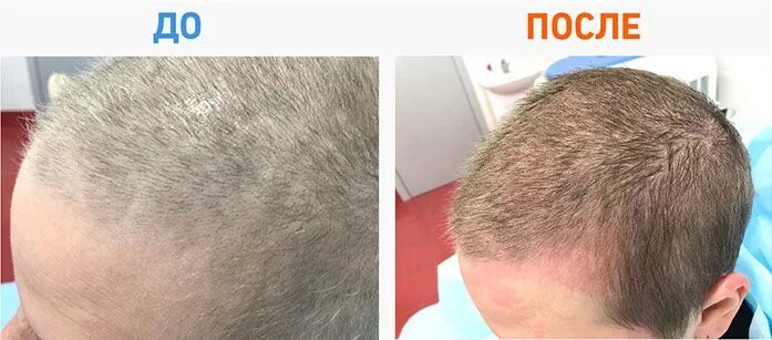 Рост волос после химиотерапии. После химиотерапии волосы растут. Выпадение волос после химиотерапии.