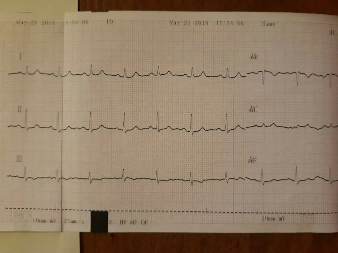нормальная кардиограмма фото. кардиограмма сердца ребенка норма. нормальная экг 50 мм/с. нормальная экг. экг p 122 мс.