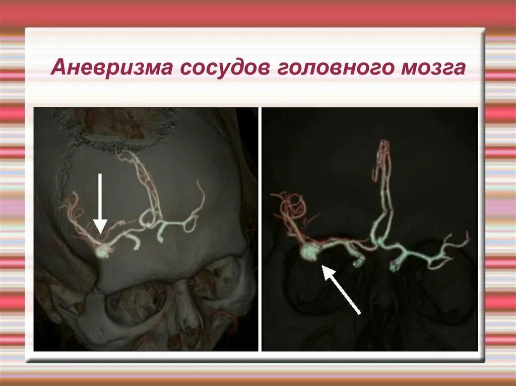 Расширение сосудов головы. Кт ангиография аневризма. Кт ангиография аневризма головного мозга. Магнитно-резонансная ангиография сосудов головного мозга. Аневризма сосудов головного мозга кт ангиография.