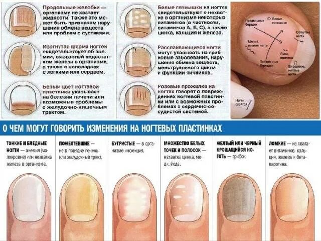 Что означают белые пятна на ногтях рук. Определить заболевание по ногтям. Выявление болезни по ногтям. Заболевания по ногтевой пластине.