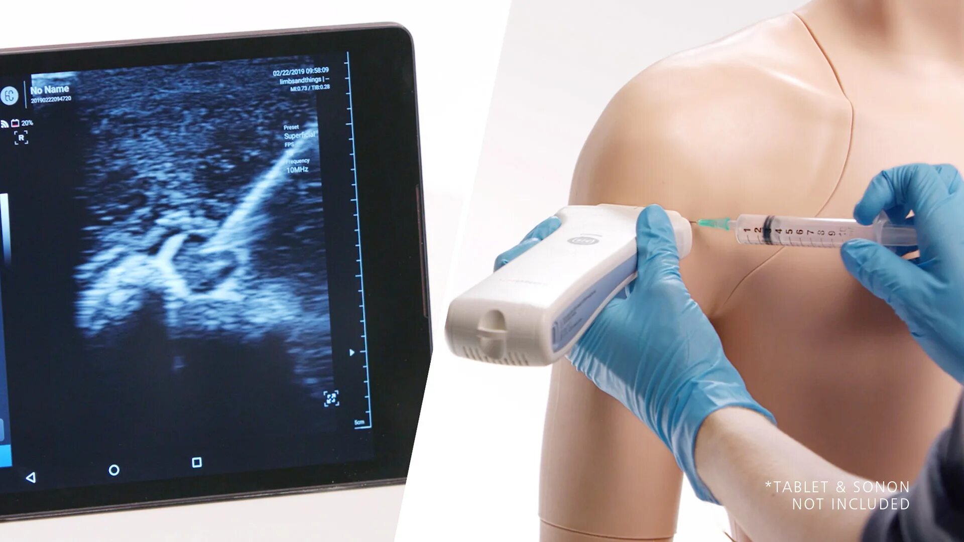 Блокада под контролем узи. Под узи навигацией. Блокада межлестничного сплетения под узи. Блокада плечевого сустава. Блокада под контролем узи.