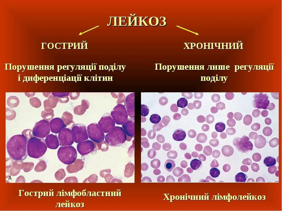 Острый лейкоз с лейкопенией. Тромбо бластный лейкоз. Лейкемический лейкоцитоз.