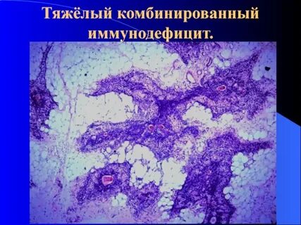 Ада ткин врожденная недостаточность