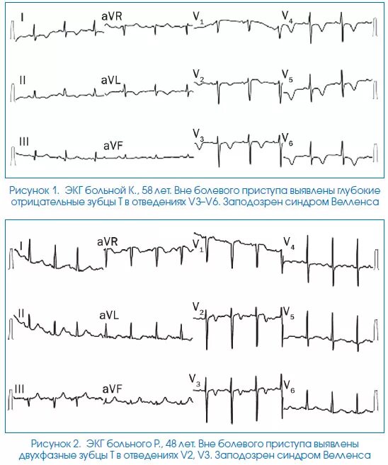 синдром wellens на экг. веленса синдром велленса. синдром велленса на экг. синдром wellens на экг. Wellens на экг.