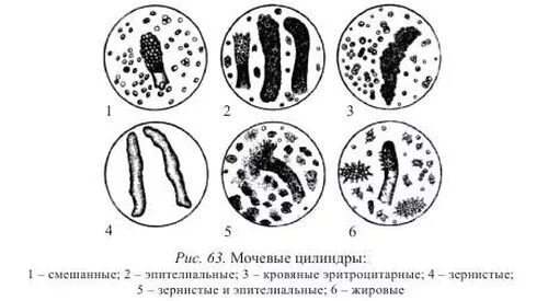 Моча цилиндры гиалиновые повышенные. Восковидные цилиндры в моче. Гиалиновые и зернистые цилиндры. Гиалиновые цилиндры в моче. Моча гиалиновые, зернистые, эпителиальные цилиндры.