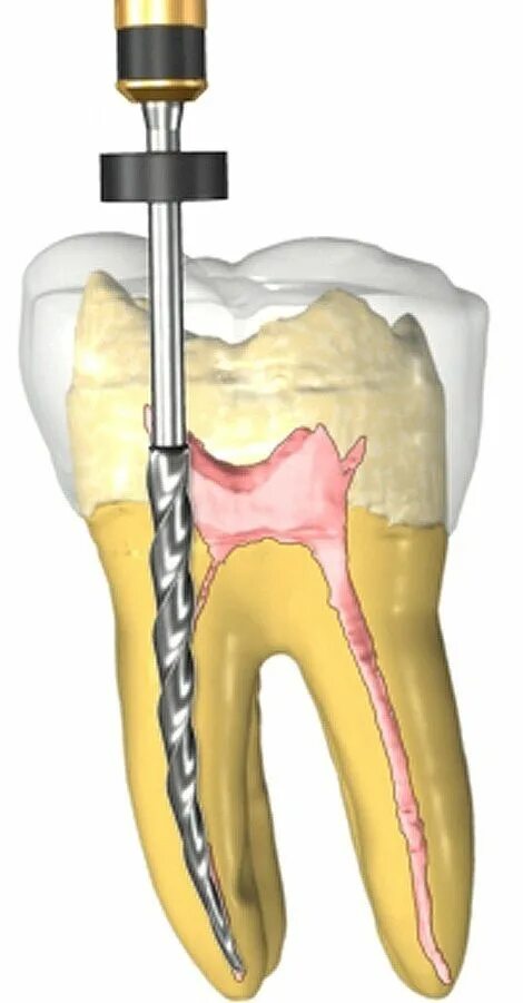 Root canal