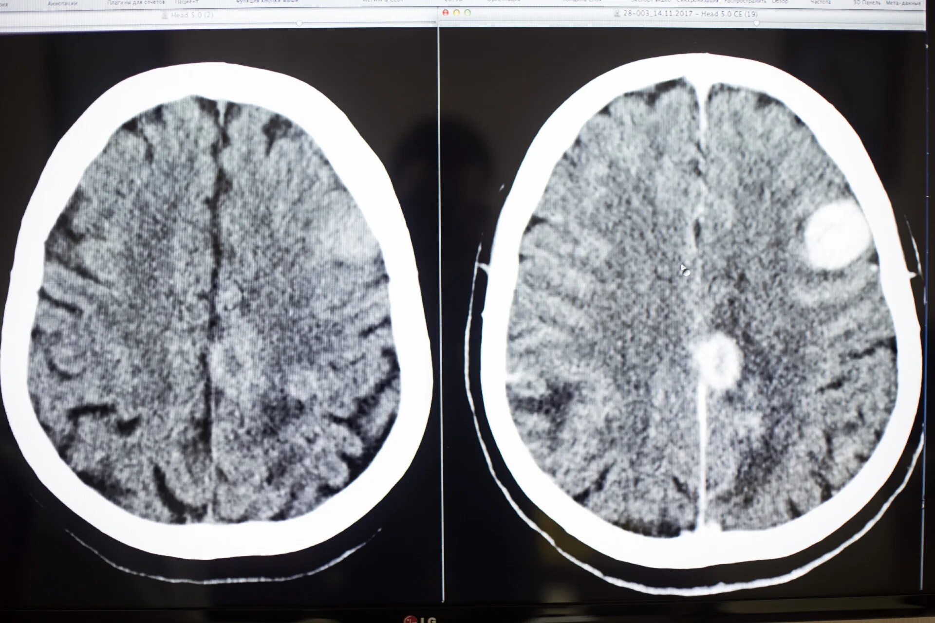 Разница кт и кт с контрастом. Опухоль головного мозга на мрт с контрастом. Опухоль головного мозга на кт с контрастом. Токсоплазмоз на кт головного мозга. Снимки опухоли мозга на мрт с контрастом.