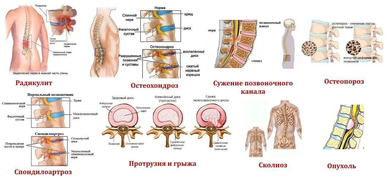 Грыжи позвоночника в поясничном отделе схема. Заболевания пояснично-крестцового отдела позвоночника. Остеохондроз, протрузия, грыжа межпозвоночного диска. Дорсопатии поясничного отдела позвоночника.