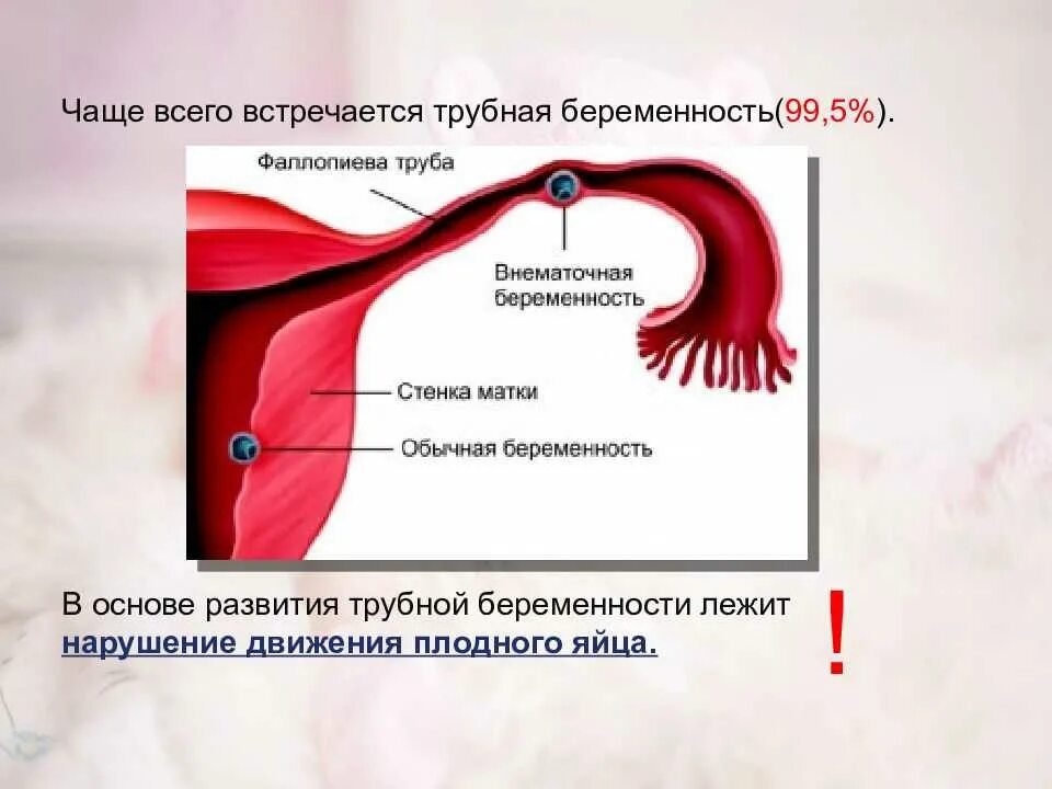 Забеременела при непроходимости труб. Внематочная Трубная беременность. Трубная локализация внематочной беременности. Эктопическая Трубная беременность. Эмбрион в маточной трубе.