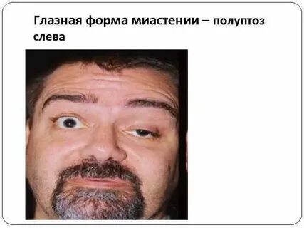 Глазная миастения
