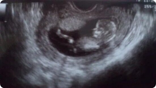 Normal 13 week baby ultrasound. - Ultrasoundfeminsider