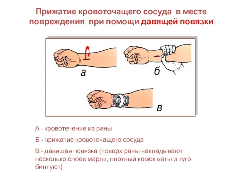 Прижатие кровоточащего сосуда в ране. Остановка кровотечения наложением давящей повязки. Наложение давящей повязки алгоритм.