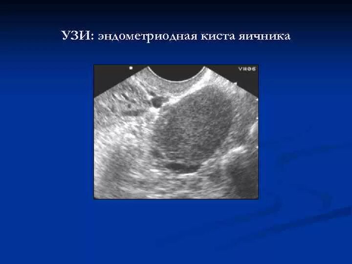 Как отличить кисту. Доброкачественная опухоль яичника УЗИ. Малигнизированная опухоль яичника. Доброкачественная киста яичника.