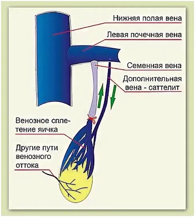 Расширение семенной вены. Семенные вены анатомия. Внутренняя семенная Вена. Варикоцеле анатомия вены.