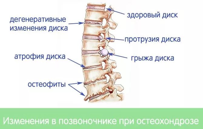 Дегенеративное изменение тел позвонков