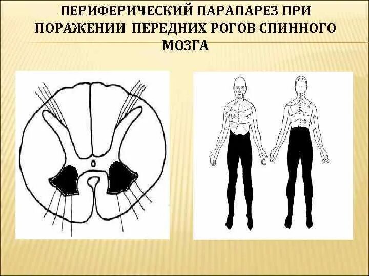 Поражение передних рогов. Поражение передних Рогов спинного мозга. Поражение мотонейронов передних Рогов спинного мозга. Симптомокомплекс поражения задних Рогов спинного мозга. Синдром поражения боковых Рогов спинного мозга.