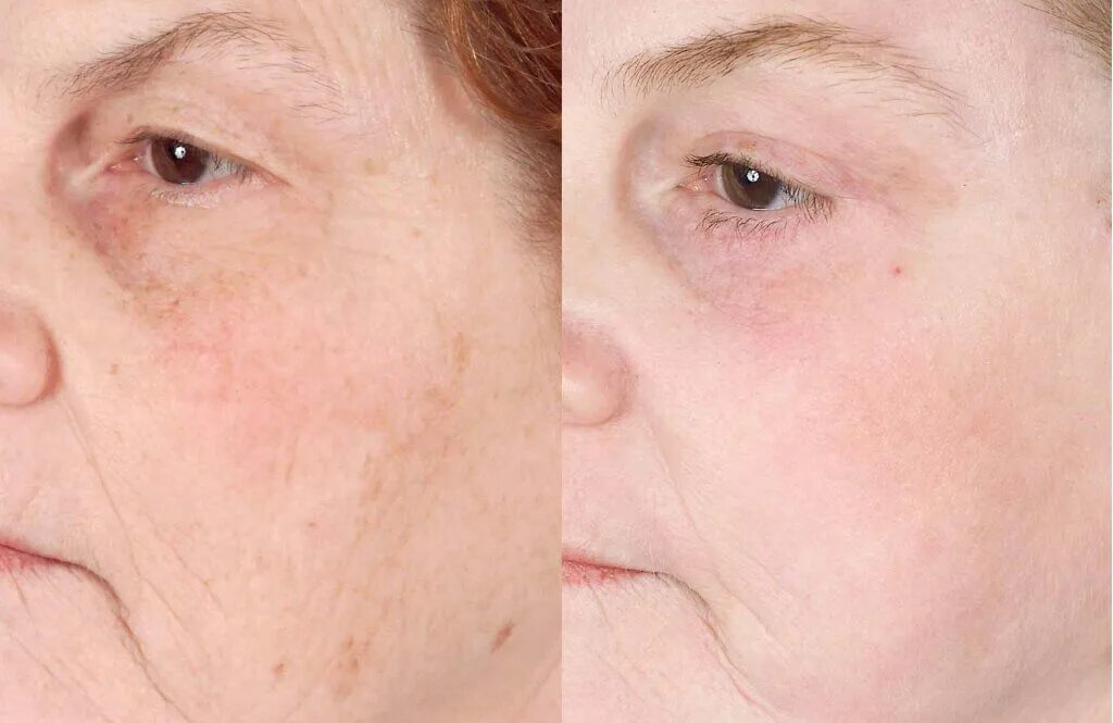 Наноперфорация рубцов. Брыли (лифтинг нефертити). Лифтинг нефертити ботоксом. Омоложение отзывы форум. Фракционный фототермолиз со2.