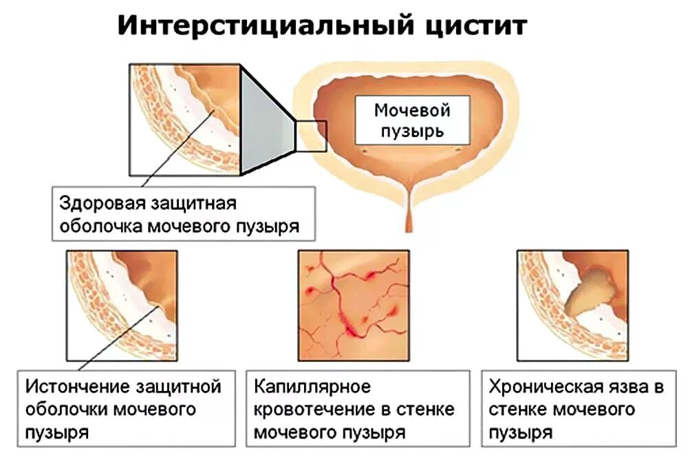 Можно греть живот при цистите. Хронический интерстициальный цистит. Язва Гуннера интерстициальный цистит. Хронический гранулярный цистит. Интерстициальный цистит цистоскопия картина.