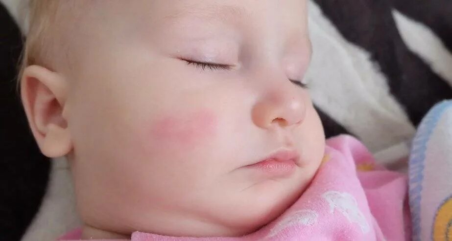 Почему щеки розовые. Красные пятна на лице у ребенка. Аллергические пятна у ребенка. Аллергические высыпания на лице у детей.