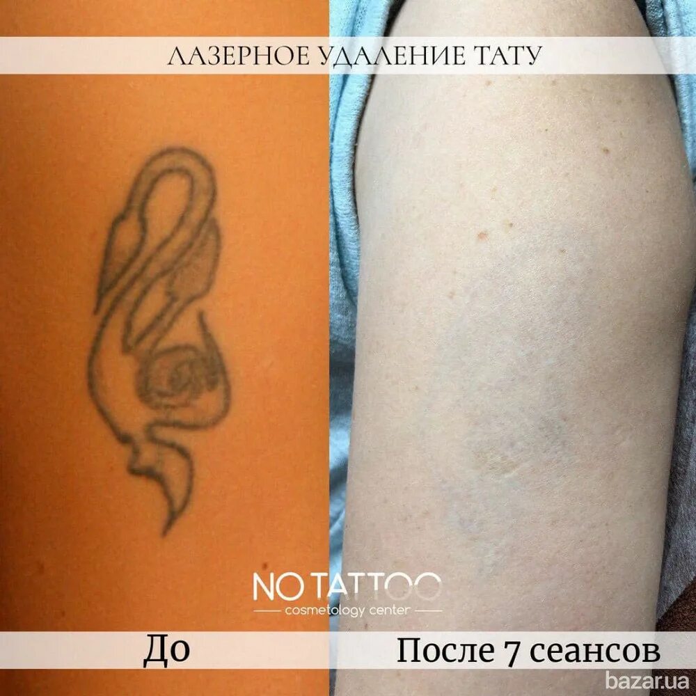 Можно пить после сеанса тату. Лазерное удаление тату. удаление тату пикосекундным лазером. пикосекундный лазер тату до и после.