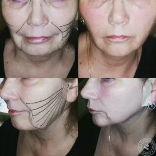 Тейпирование лица фото до после