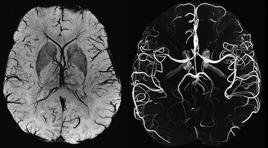 Венография головного мозга. Мрт головного мозга с ангиографией. Мрт ангиография сосудов головного мозга. МРА (магнитно-резонансная ангиография). Мрт сосудов головного мозга (мрт-ангиография).