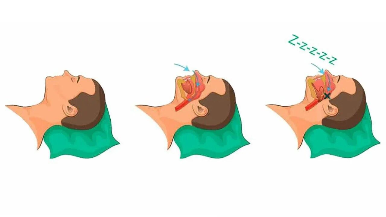 Операция от храпа лазером. Аппарат для ночного апноэ. Операция от храпа лазером. Храп хирургическим путем. Храп хирургическим путем.