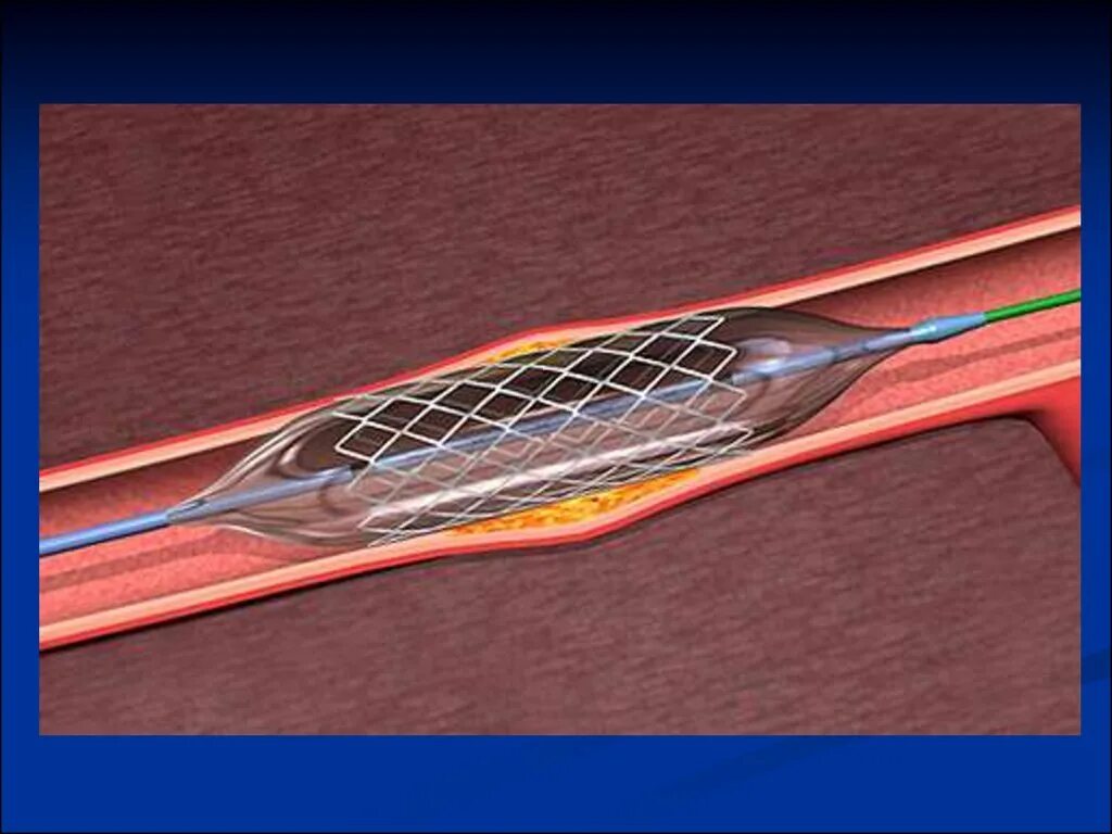 Болит стент. Стентирование сосудов сердца. Стентирование коронарных артерий. Коронарное стентирование сосудов сердца.