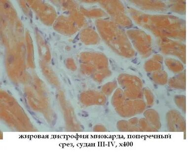 Алкогольная жировая дистрофия