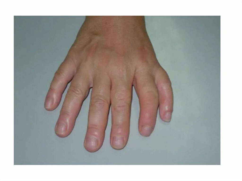 На 1 руке 6 пальцев. Полидактилия верхних конечностей. Постаксиальная полидактилия кистей. Полидактилия шестипалость.