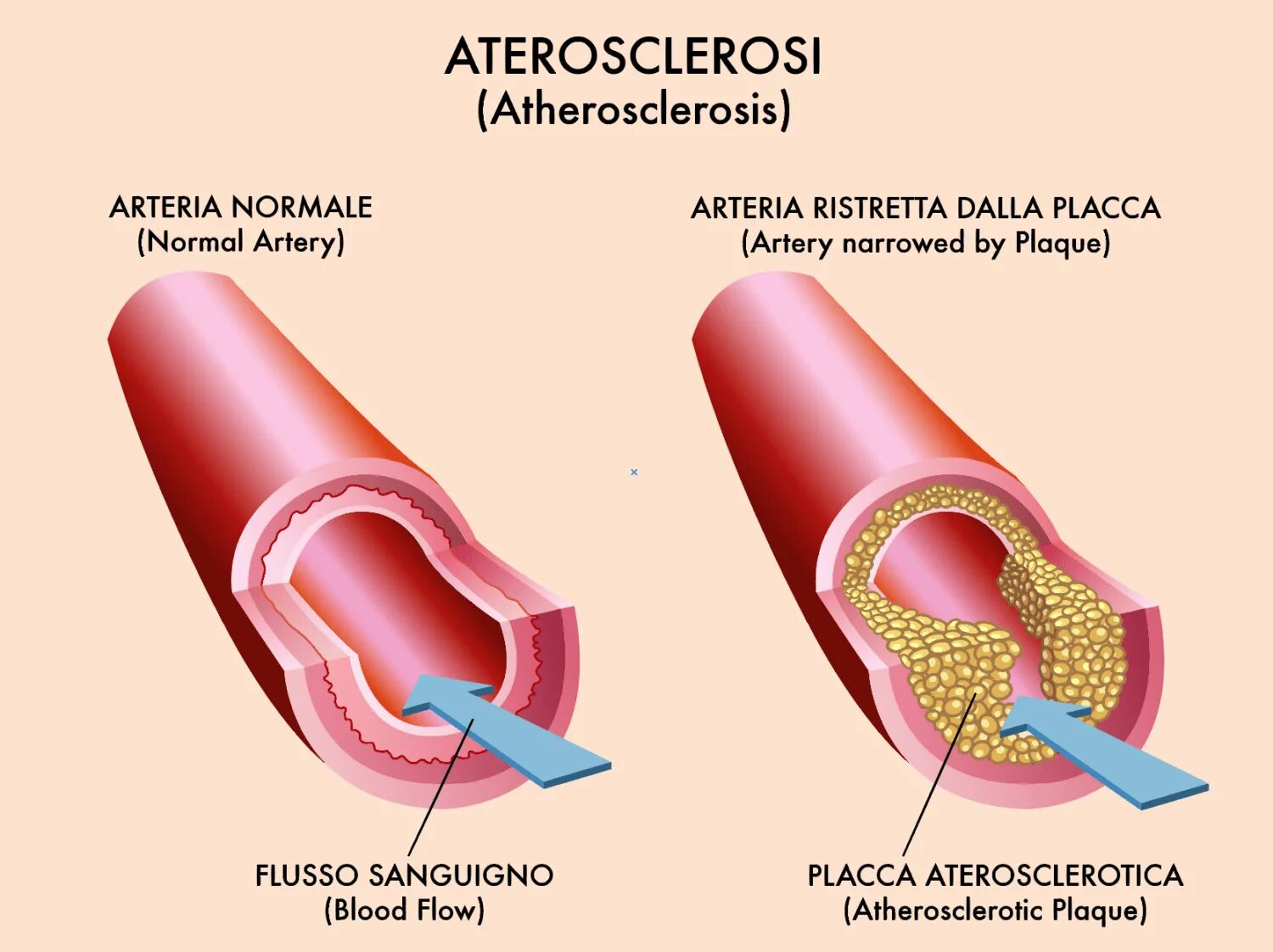 Расширение стенок сосудов. Атеросклеротическая бляшка. Атеросклеротическое сужение сосудов.